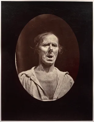 Figure 54: Abaissement volontaire de la mâchoire inférieure: mouvement inexpressif — Guillaume Duchenne de Boulogne